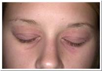 Eczema Pictures Chronic Eczema of the eye lids.jpg